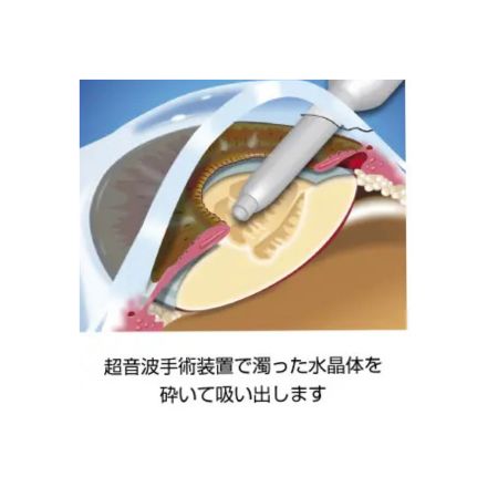 白内障手術の工程①