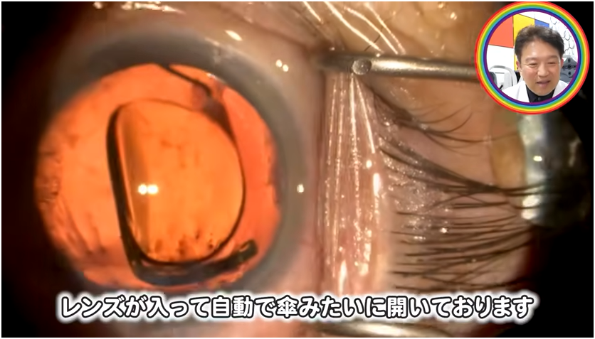 白障手術の流れを解説　⑩