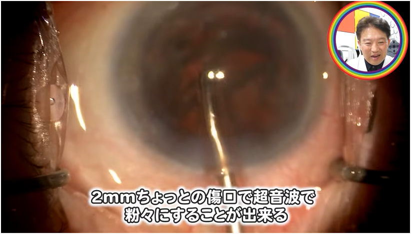 白内障手術の流れを解説　⑦