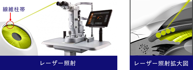 緑内障のレーザー治療(選択的レーザー線維柱帯形成術)