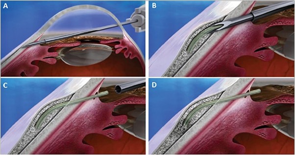 XEN Gel Stent（ゼンジェルステント）