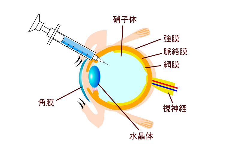 硝子体注射