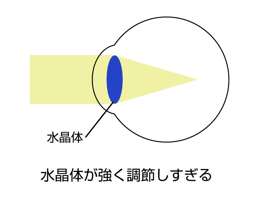 仮性近視（偽近視）