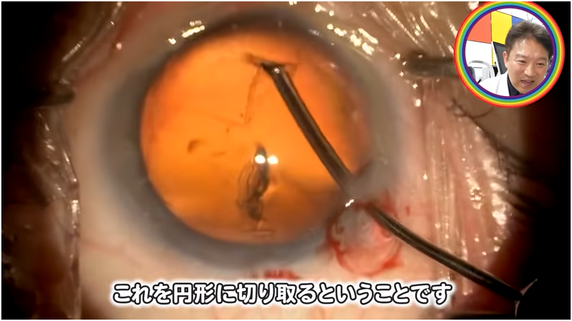白内障手術の流れを解説　④