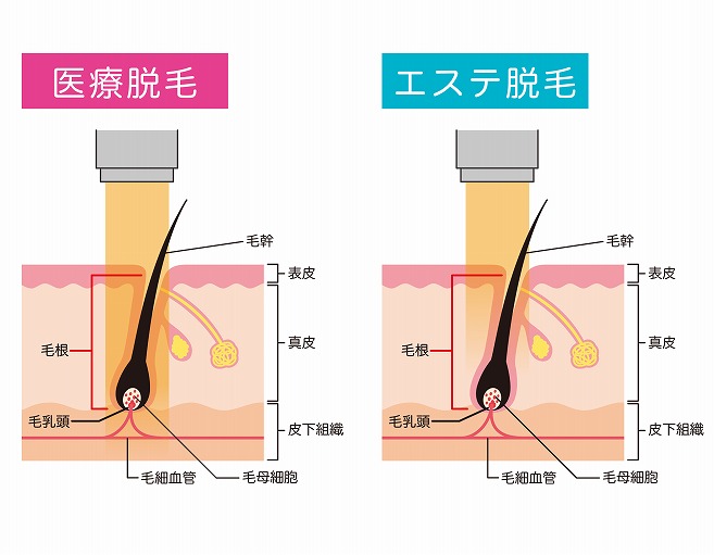 医療脱毛とエステサロンの脱毛の違い