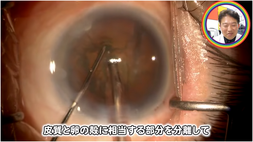 白内障手術の流れを解説　⑤