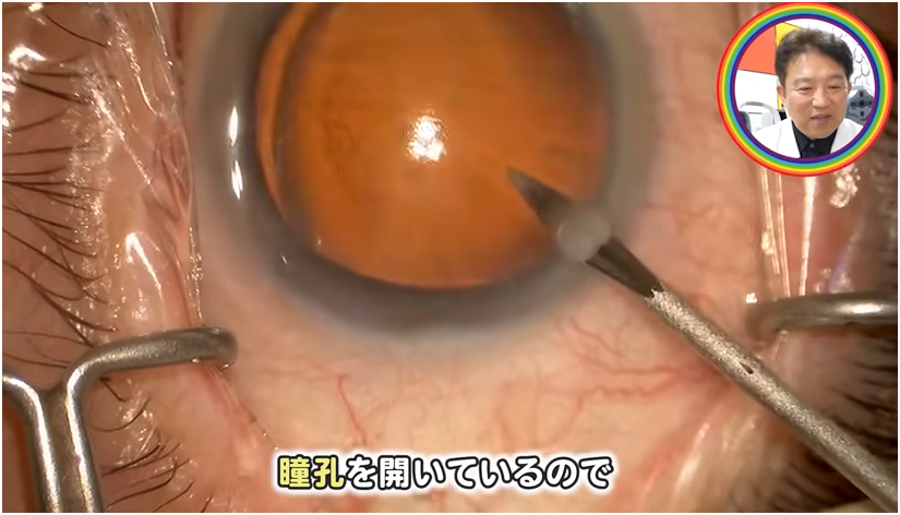 白内障手術の流れを解説①