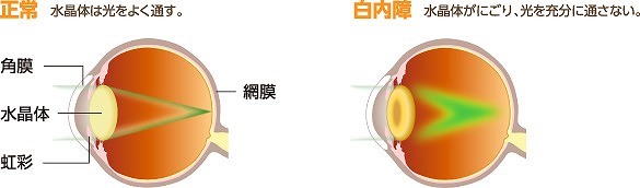 目の中の水晶体が濁る白内障