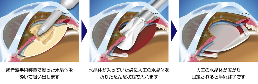 日帰り白内障手術について