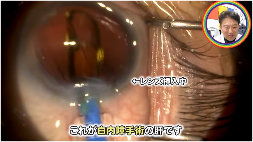 白障手術の流れを解説　⑨