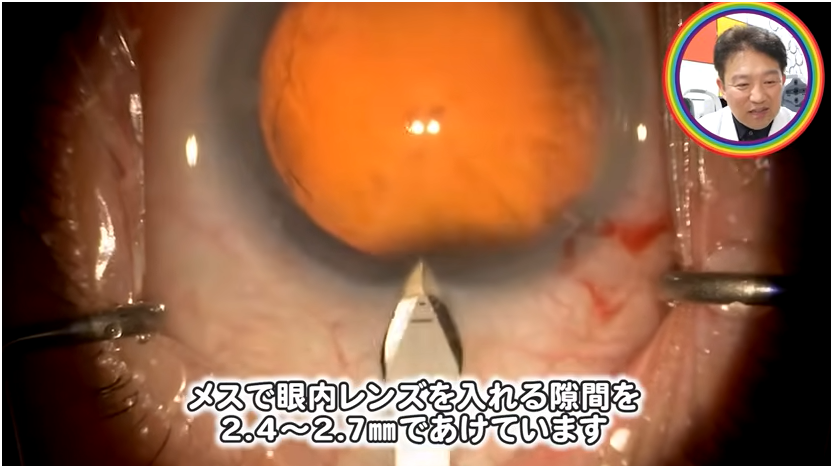 白内障手術の流れを解説　③