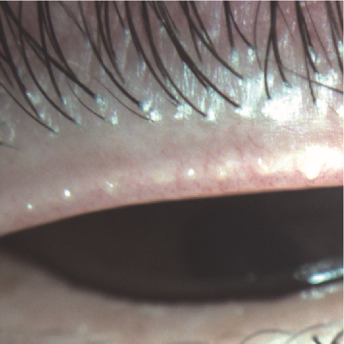 マイボーム線詰まり