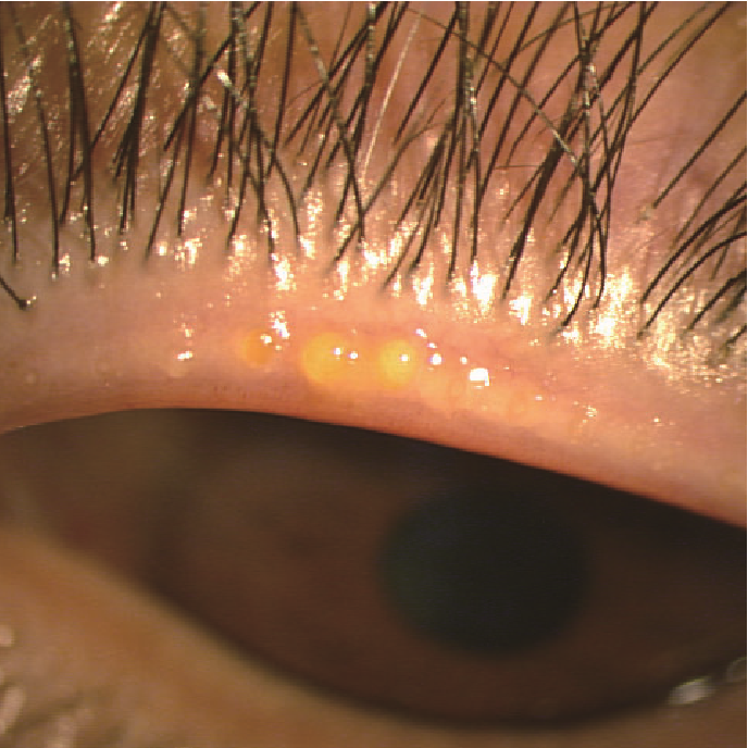 マイボーム線詰まりタピオカサイン