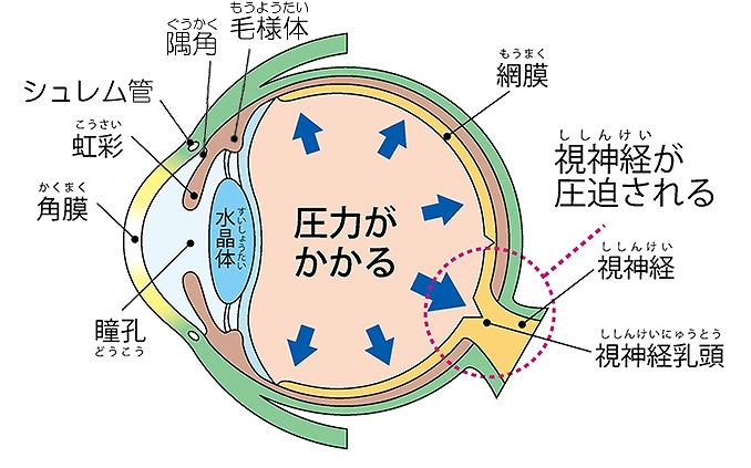 緑内障の原因は？