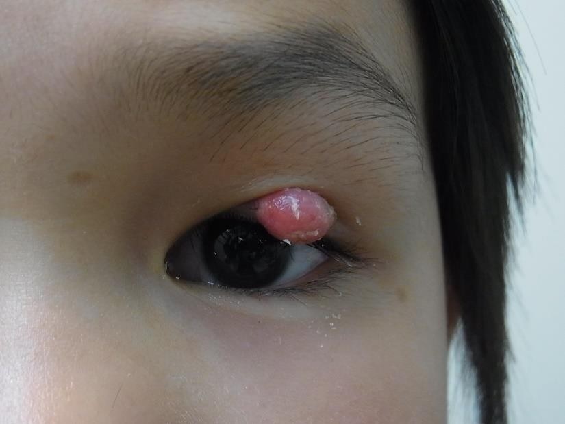 眼瞼腫瘍の症例