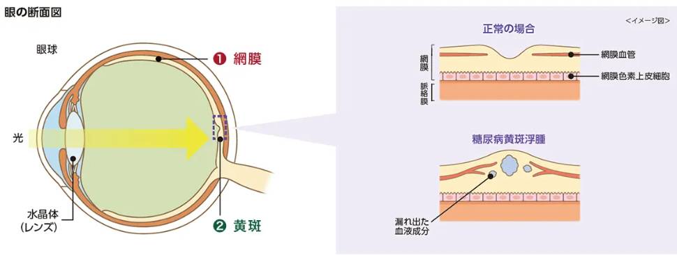 黄斑浮腫