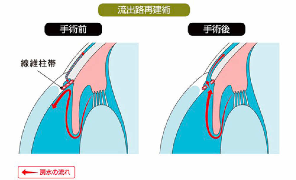 ●	線維柱帯切開術（トラベクロトミー）
○	眼圧を下げるために線維柱帯を部分的に切開し、房水の流れを改善します。
