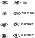 斜視について