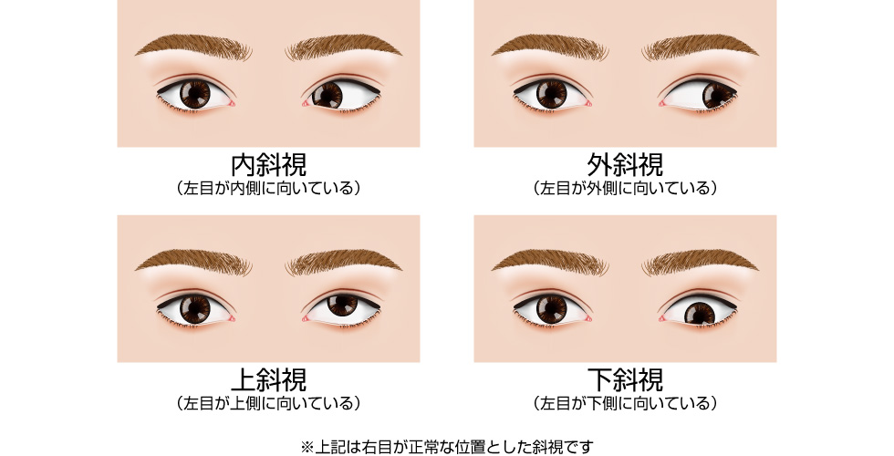 斜視の原因は様々