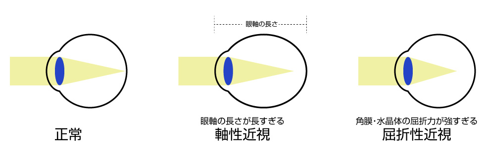 近くが見えて遠くは見えにくい近視