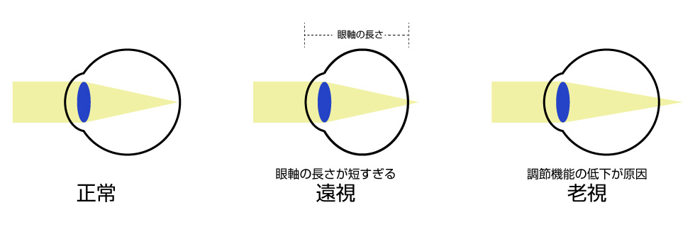 遠くも近くもぼんやり見える遠視