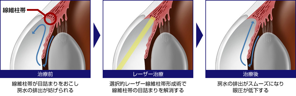 選択的レーザー線維柱帯形成術（SLT）の仕組み