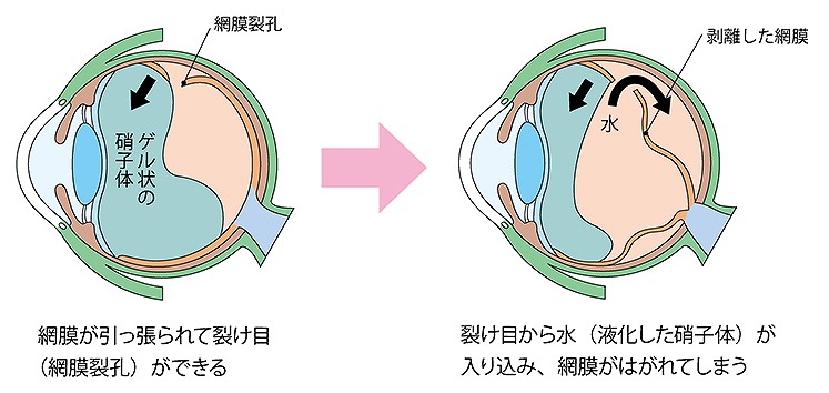 網膜裂孔・網膜剥離