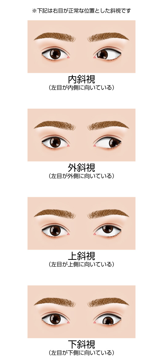 斜視の原因は様々