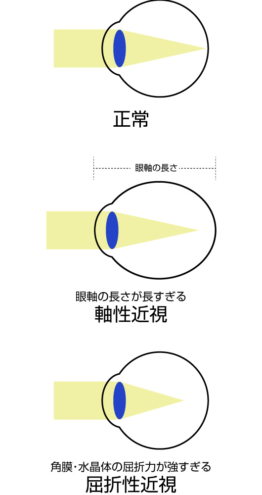 近くが見えて遠くは見えにくい近視