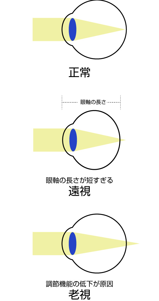 遠くも近くもぼんやり見える遠視