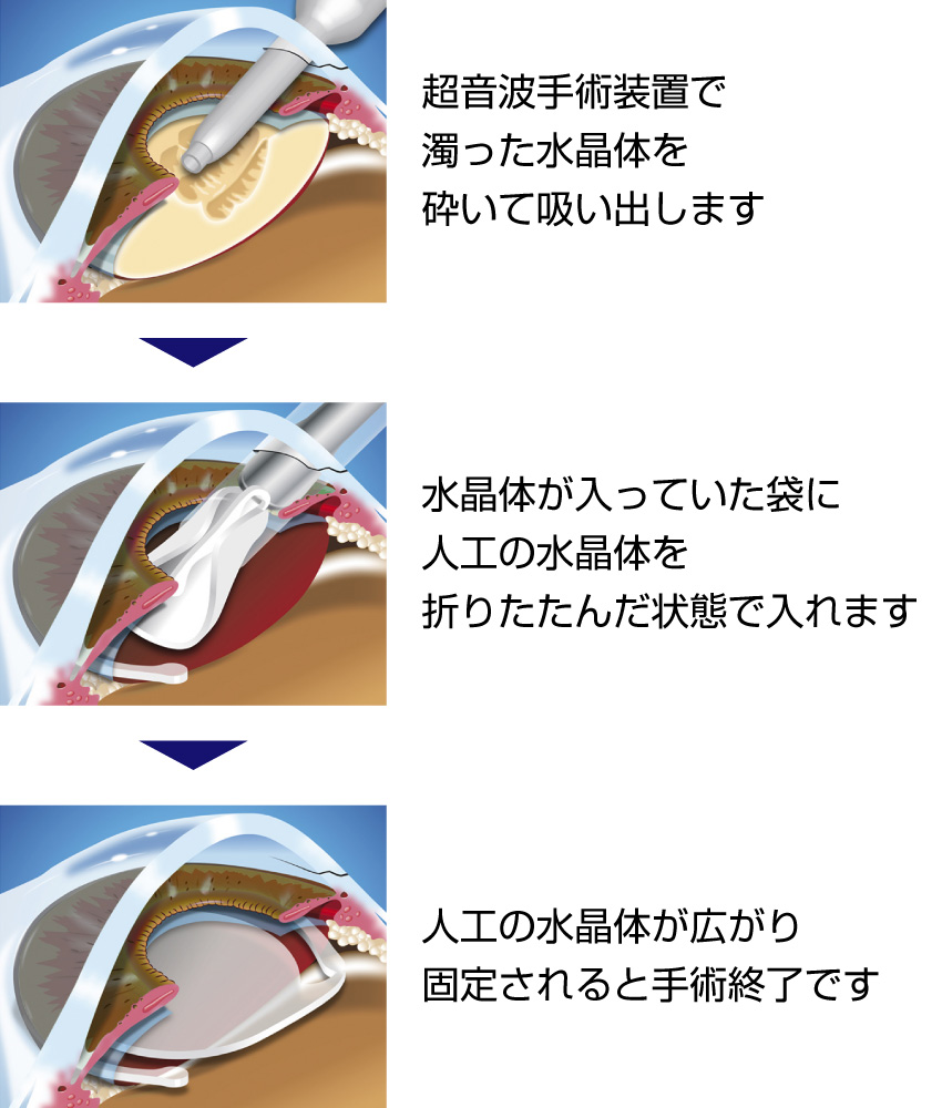 日帰り白内障手術について