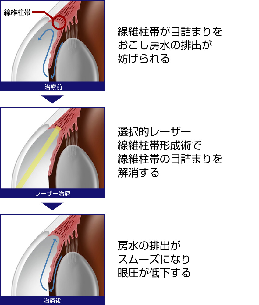 選択的レーザー線維柱帯形成術（SLT）の仕組み