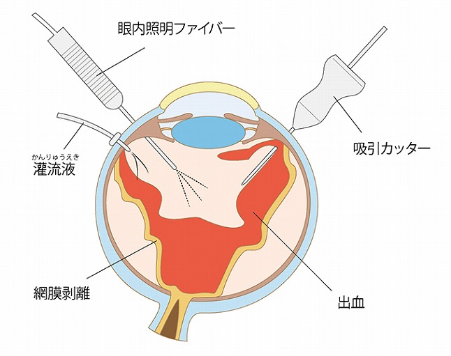 網膜の機能を回復させる硝子体手術